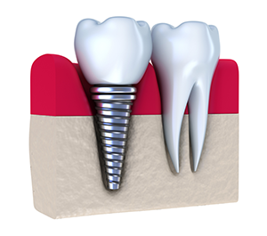 Implant Dentistry Walled Lake, Wixom, Novi, MI Family Dentist